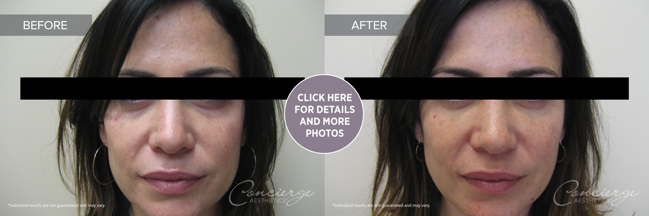 Juvederm Ultra - Under the Eyes - Before and After Photos