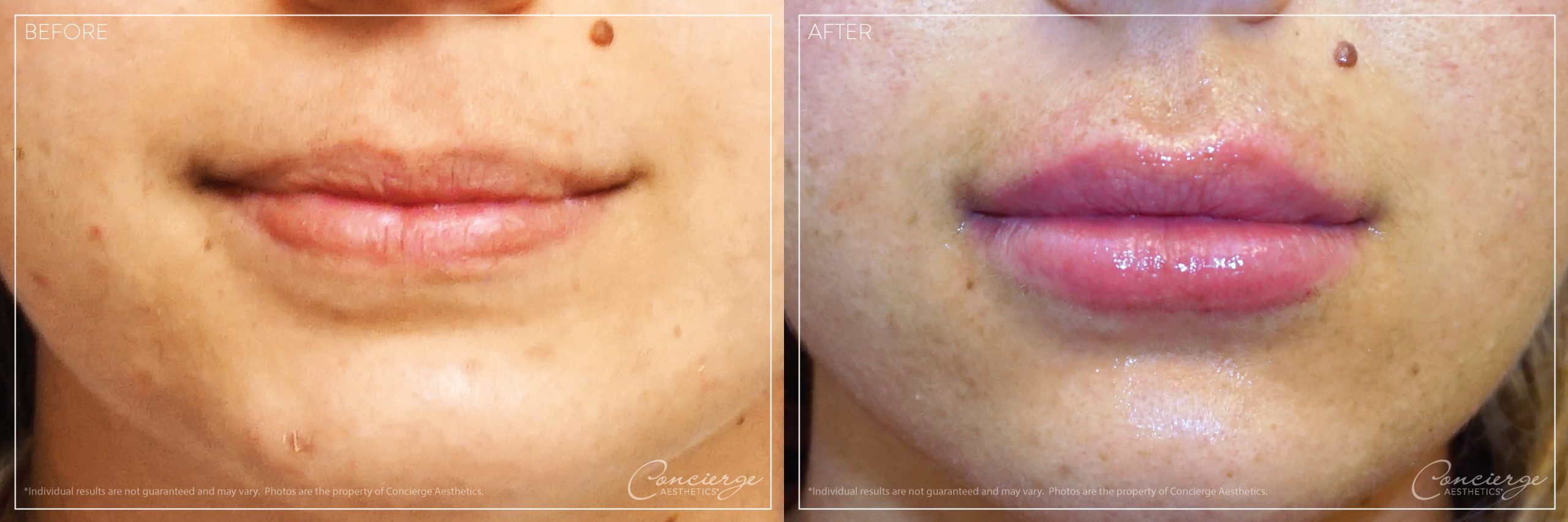 Before and After: Juvederm Volbella and Vollure - Lips | Concierge Aesthetics