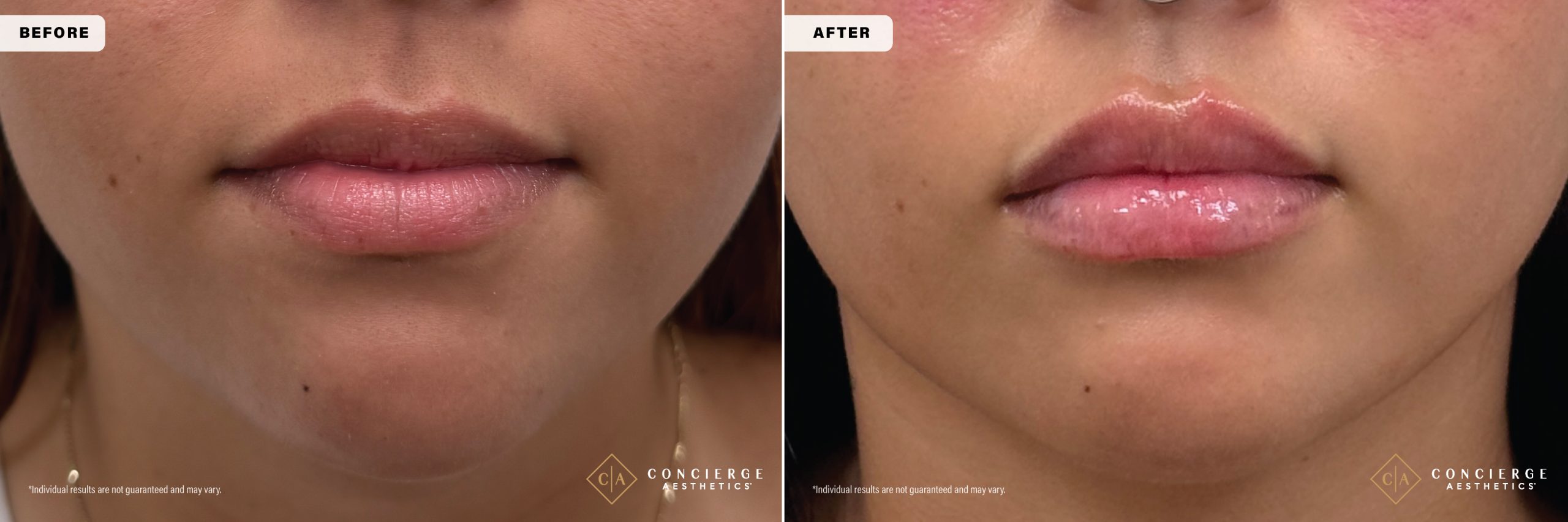 Before and after lip filler in Irvine showing enhanced fullness, improved balance, and natural proportions after second treatment.