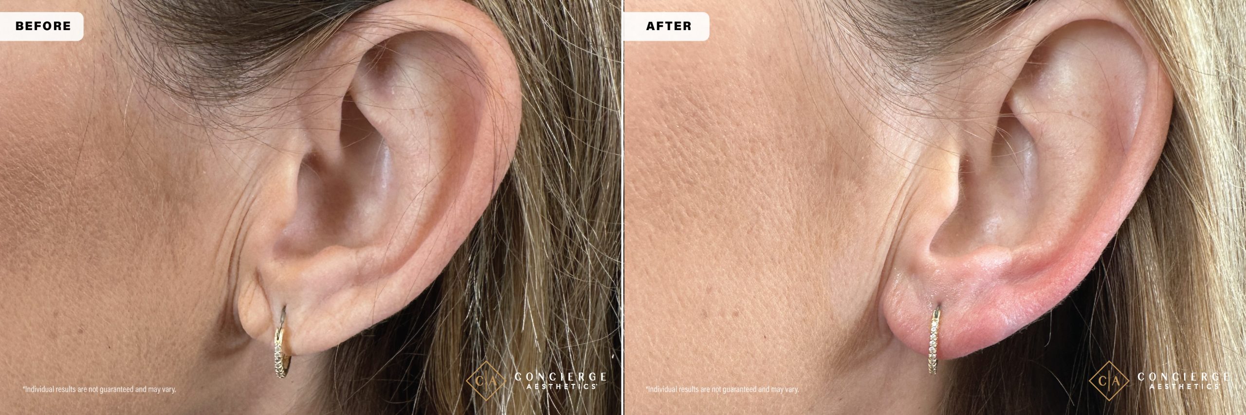 Side-by-side comparison of a mid-40s patient’s earlobe before and after HA dermal filler treatment, showing visible improvement in volume, smoothness, and earring support.