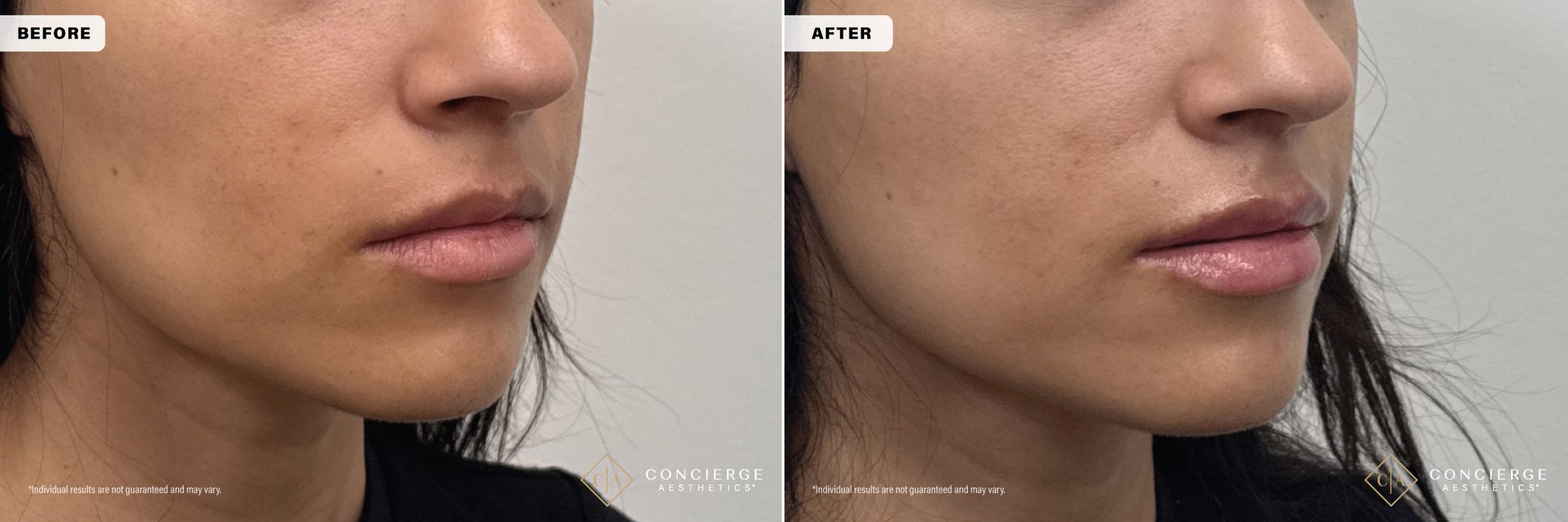 Lip filler correction before and after showing natural lip enhancement and improved upper lip height after dissolving migrated filler at Concierge Aesthetics in Irvine CA.