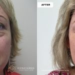 Before and after under-eye filler treatment showing long-term tear trough correction and cheek support. Before image at age 56 demonstrates under-eye hollows and shadowing; after image at age 67 shows a smoother under-eye contour and refreshed appearance with only one touch-up over 11 years.